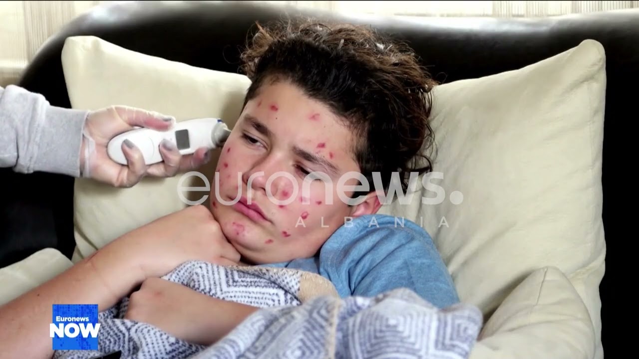 Figures: Albania Follows Europe’s Trend, Measles Cases Drop Significantly
